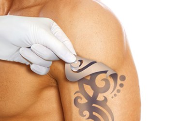 Выведение татуировки